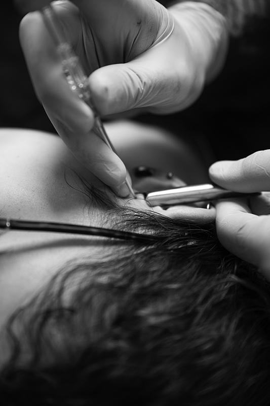 piercing zetten tegen migraine